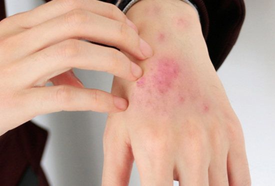 青岛效果好的湿疹康复中心排名一览——湿疹不及时治疗有危害吗？